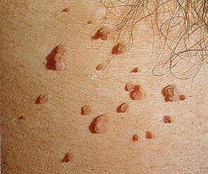 papillomavirus manusia pada kulit