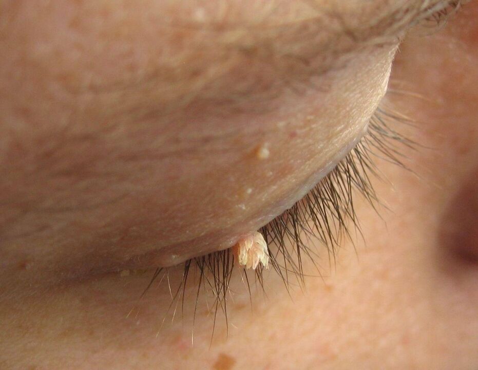 papilloma pada kelopak mata