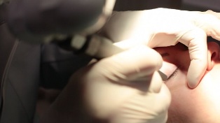 Pembuangan laser dari papilloma pada kelopak mata